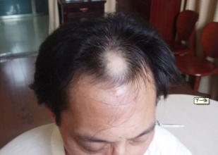 脱发的治疗方法有哪些